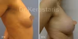 Πλαστική στήθους και εικόνες 8 Πρίν και Μετά Αυξητική Στήθους