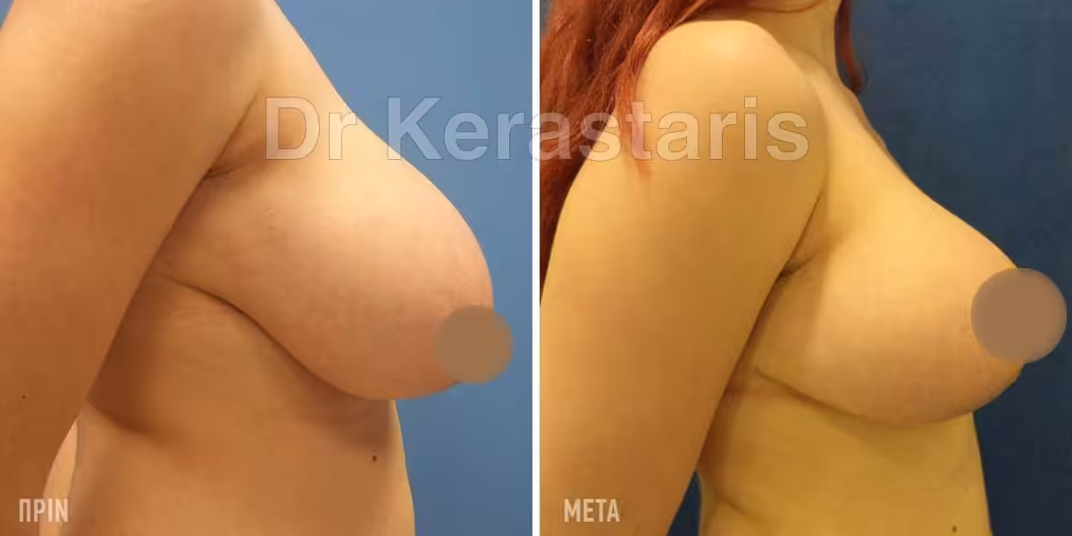Πλαστική στήθους και εικόνες 18 Πρίν και Μετά Ανόρθωση & Σμίκρινση Στήθους