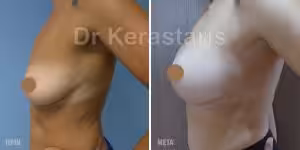 Πλαστική στήθους και εικόνες 13 Πρίν και Μετά Αυξητική Στήθους