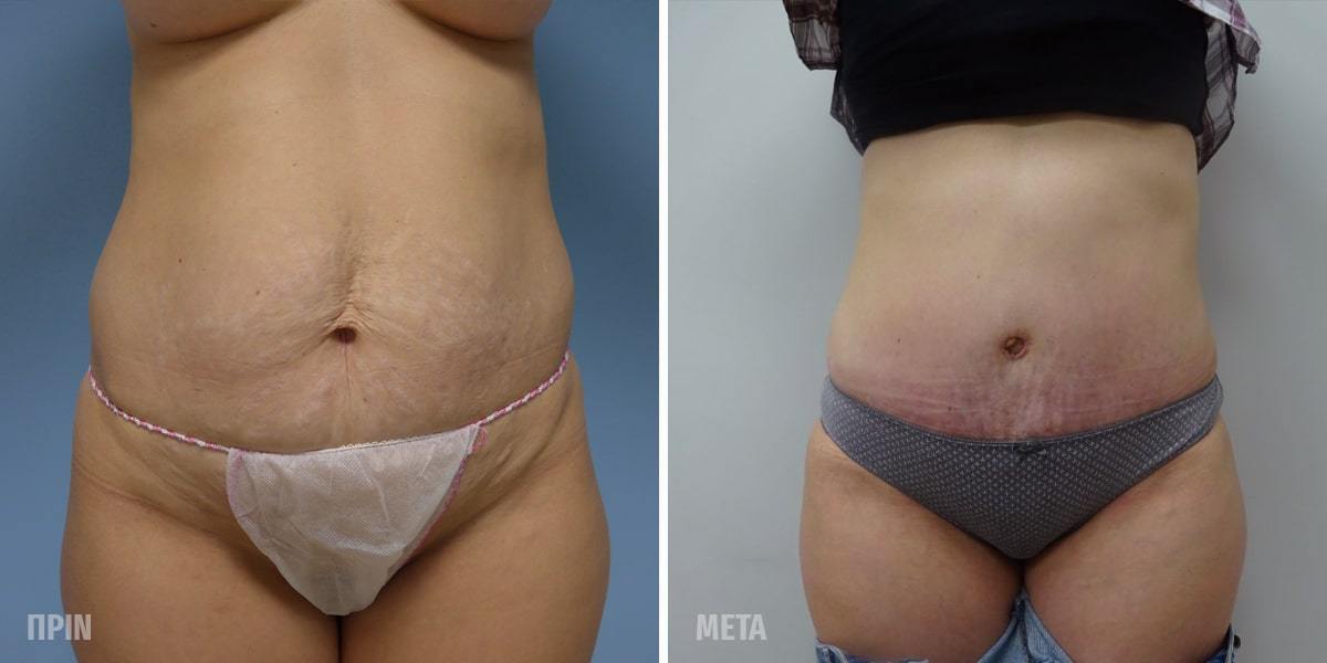 Πριν και Μετά Κοιλιοπλαστική Για Γυναίκες