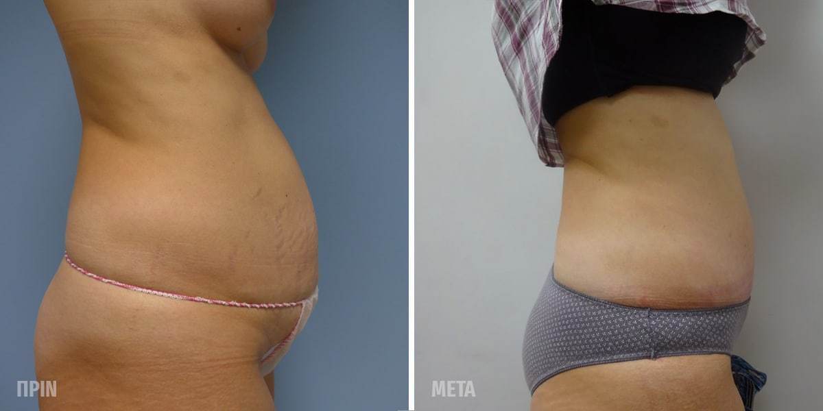 Πριν και Μετά Κοιλιοπλαστική Για Γυναίκες