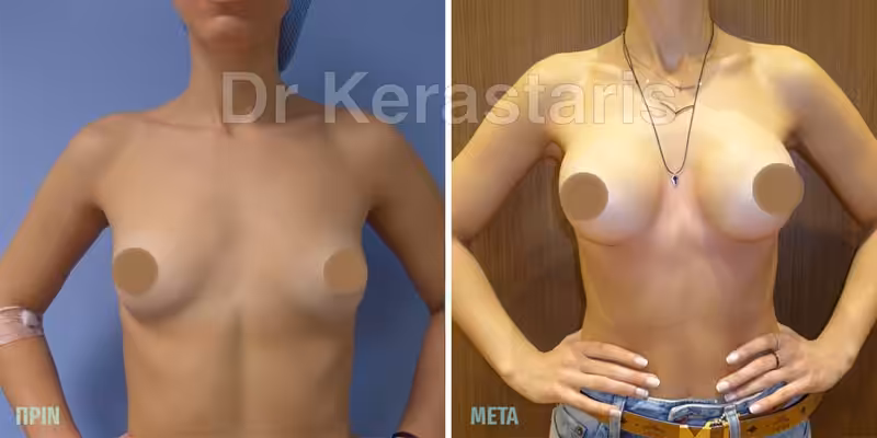 Πλαστική στήθους και εικόνες 30 Πρίν και Μετά Ανισομαστία