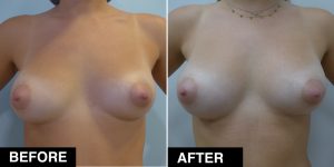 auxitiki-lipos-before-after1