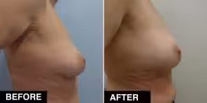 auxitiki-lipos-before-after2