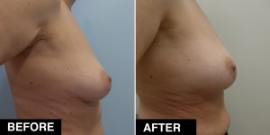 auxitiki-lipos-before-after2
