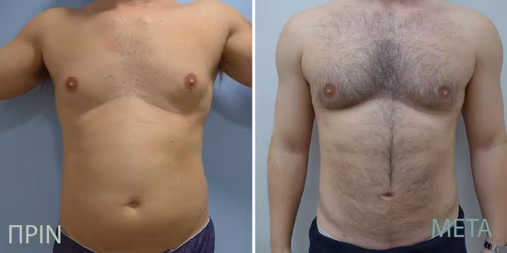 Vaser Lipo Τι Είναι: 4D High Definition Λιποαναρρόφηση με Άριστα Αποτέλεσμα 1 Vaser Lipo Πριν Μετά Άντρες 1