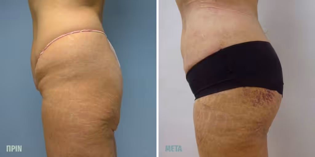 Vaser Lipo Τι Είναι: 4D High Definition Λιποαναρρόφηση με Άριστα Αποτέλεσμα 3 Vaser Lipo Πριν Μετά Γυναίκες 1
