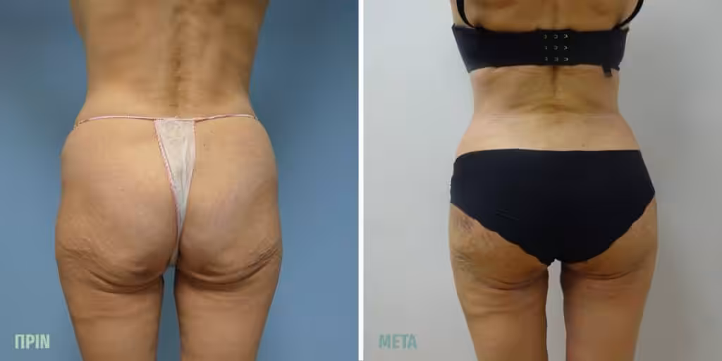 Vaser Lipo Τι Είναι: 4D High Definition Λιποαναρρόφηση με Άριστα Αποτέλεσμα 4 Vaser Lipo Πριν Μετά Γυναίκες 2