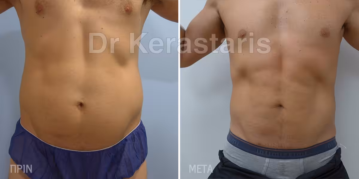 Περιττό Λίπος 1