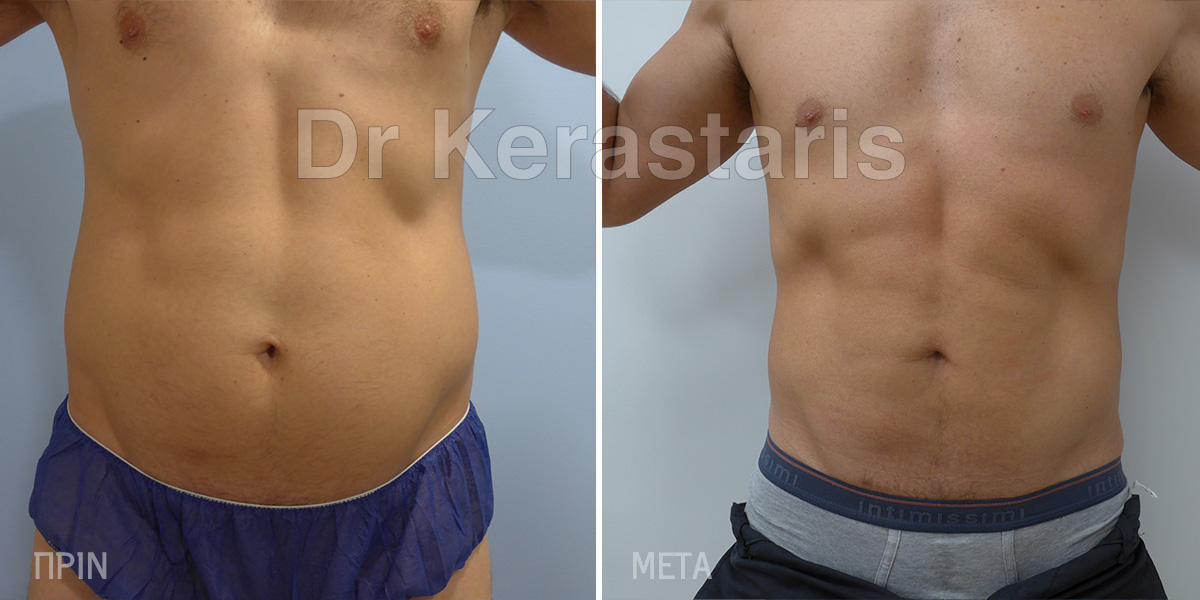 Vaser Lipo Before & After 1