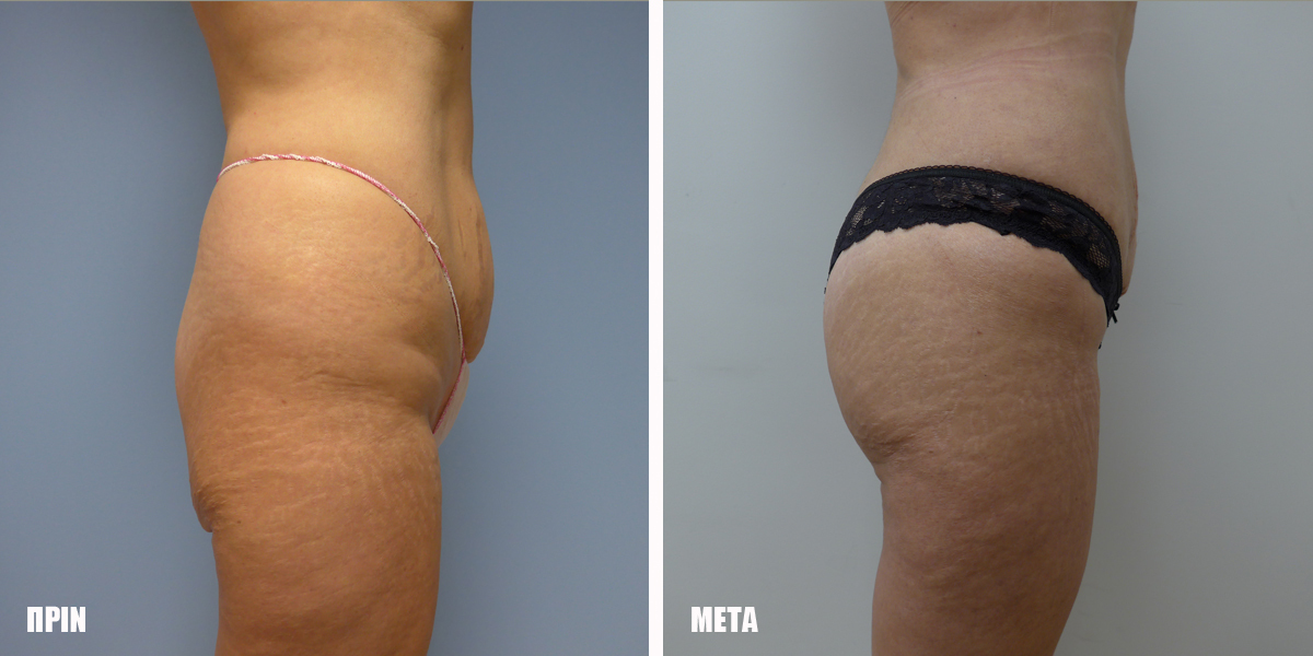 Vaser Lipo Before & After 2