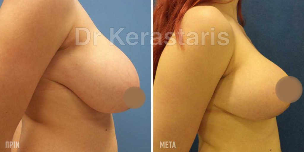 Μειωτική Στήθους Παρενέργειες: Θα μου αφήσει ουλές; 3 Μειωτική Στήθους Παρενέργειες 3